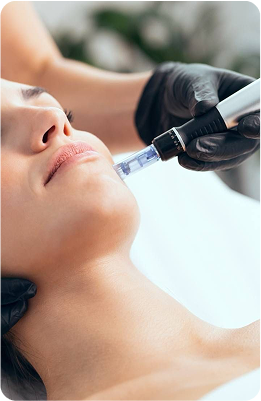 imagem Microagulhamento