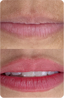 imagem Micropigmentação lábial